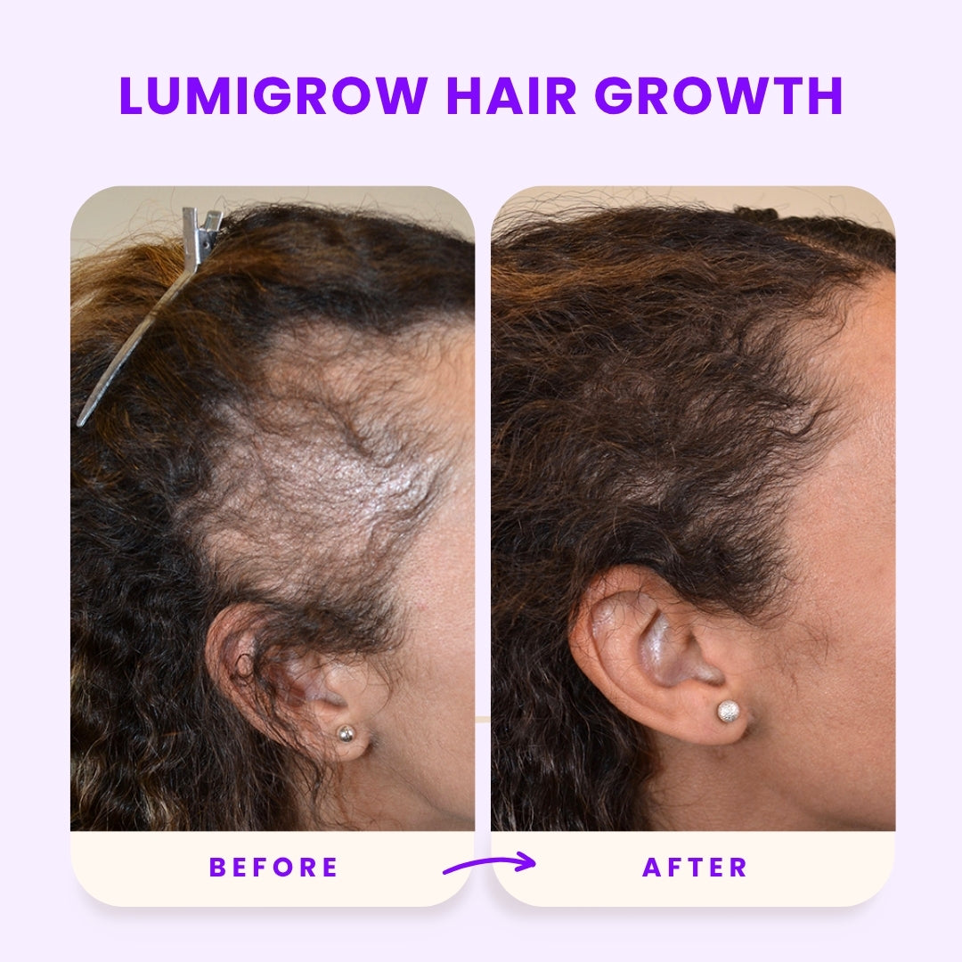 Lumigrow Hair Growth Gummies ~ Clinically proven formula for real results: